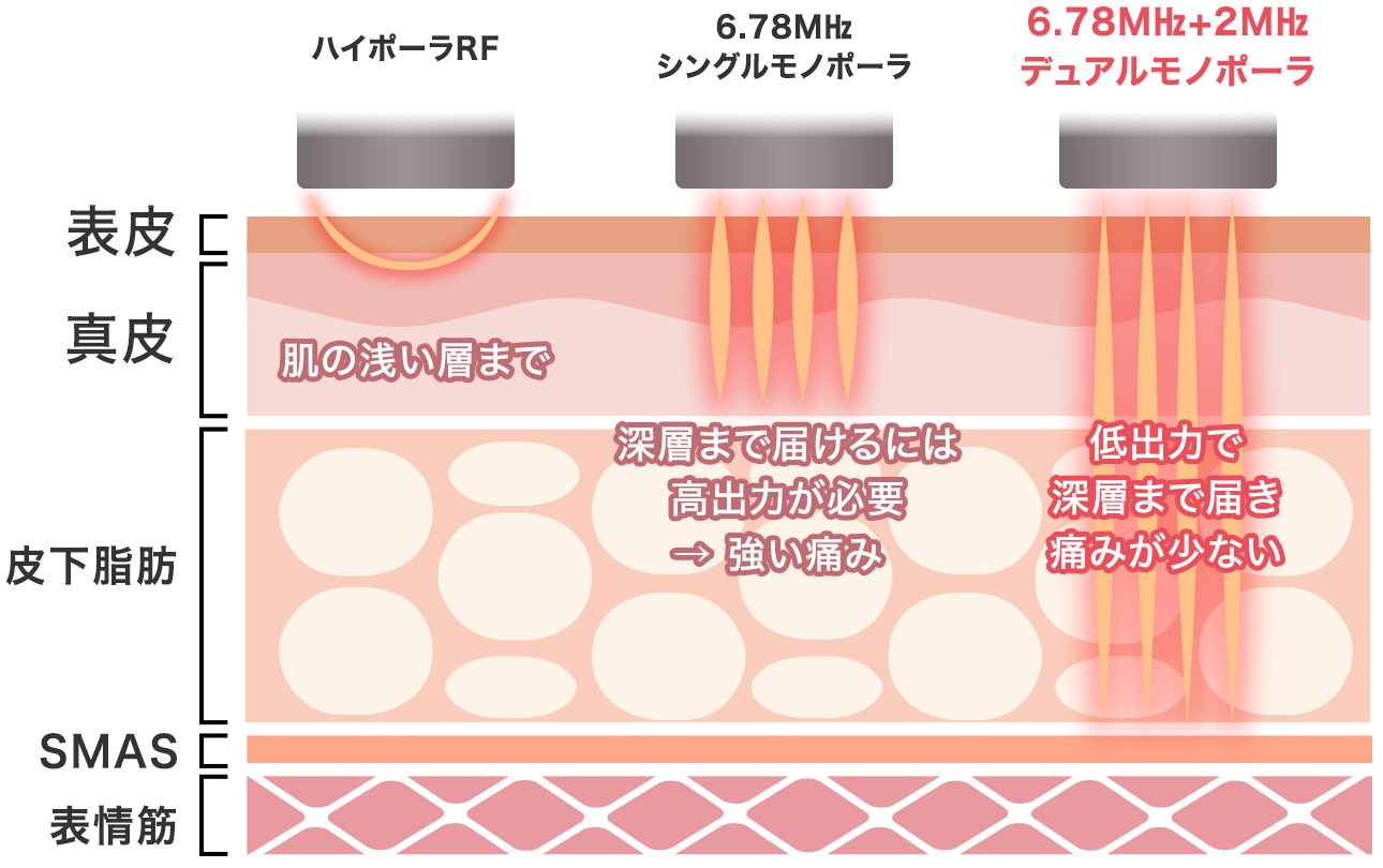 XERFとは