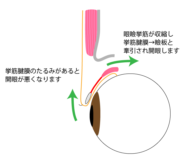 眼瞼下垂症 解剖図