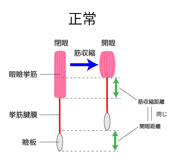 眼瞼下垂症 簡易図