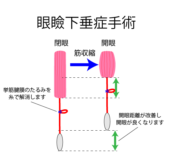 眼瞼下垂症 簡易図