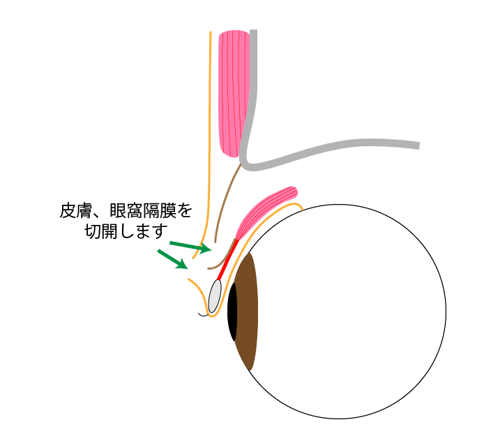 切開法