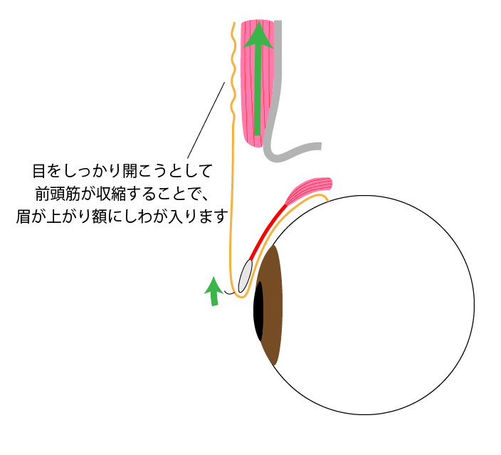 眼瞼下垂症 解剖図