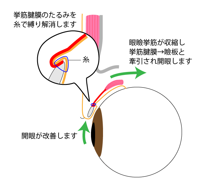 糸による治療