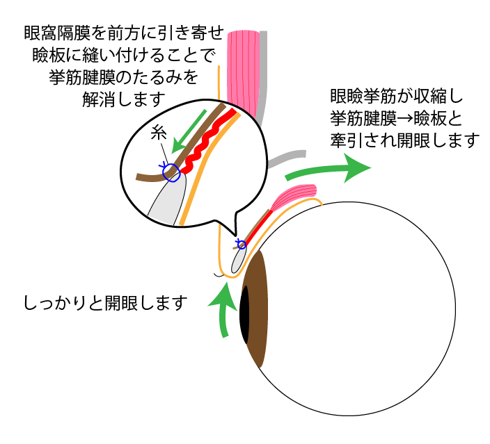 切開法