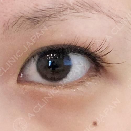 優しい目元になる、誰からも愛されるタレ目切開法(3週間後)(20代女性) BEFORE