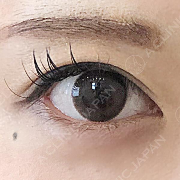その日のうちにたれ目へ☆たれ目形成術(クイック法)＋目尻切開の症例です。(20代女性) AFTER