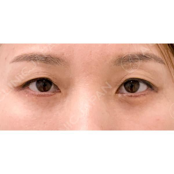 老化のサイン！目の下のクマをスッキリ解消♪目の下のたるみ取りの症例です！【40代女性】 AFTER