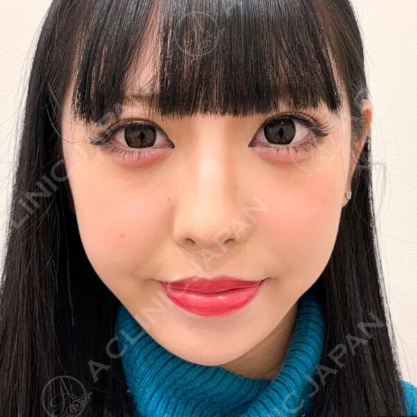 人中(鼻の下)が短くなると美人度がぐっと増します！人中短縮術(鼻下縮小術)切開法の症例写真です(20代女性) AFTER
