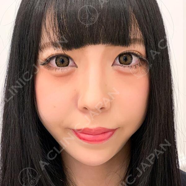 人中(鼻の下)が短くなると美人度がぐっと増します！人中短縮術(鼻下縮小術)切開法の症例写真です(20代女性) BEFORE