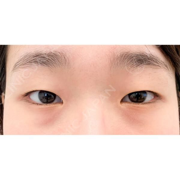 パッチリ二重もナチュラル二重も自由自在に♪二重術埋没法の症例写真です(20代女性) BEFORE