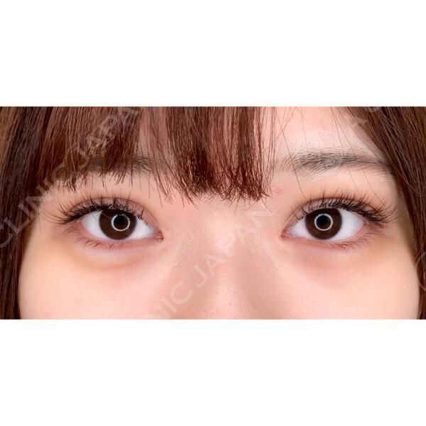 二重術埋没法でパッチリ可愛い二重に♪ダウンタイムも最小限！二重術埋没法の症例写真です(20代女性) AFTER