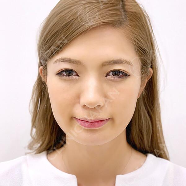 口横のお肉・フェイスラインのたるみも自然にボリュームダウン！(30代女性) BEFORE