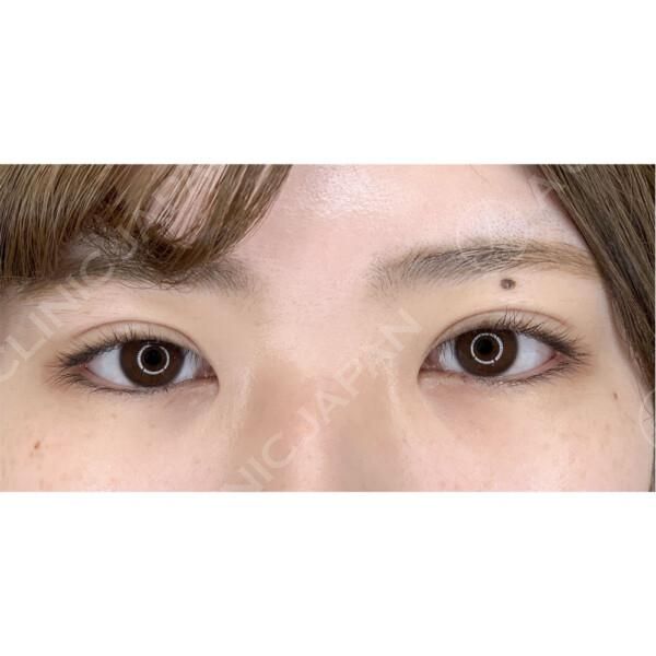 ダウンタイムが最小限の二重埋没法で、お目元が優しい印象に♪(20代女性) AFTER