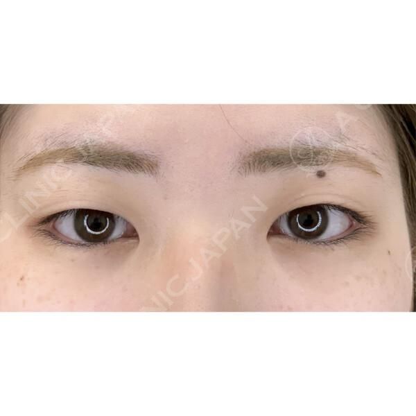 ダウンタイムが最小限の二重埋没法で、お目元が優しい印象に♪(20代女性) BEFORE