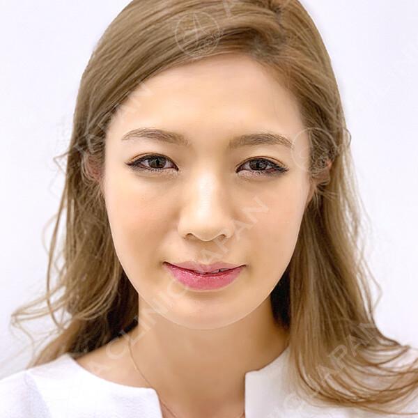 口横のお肉・フェイスラインのたるみも自然にボリュームダウン！(30代女性) AFTER