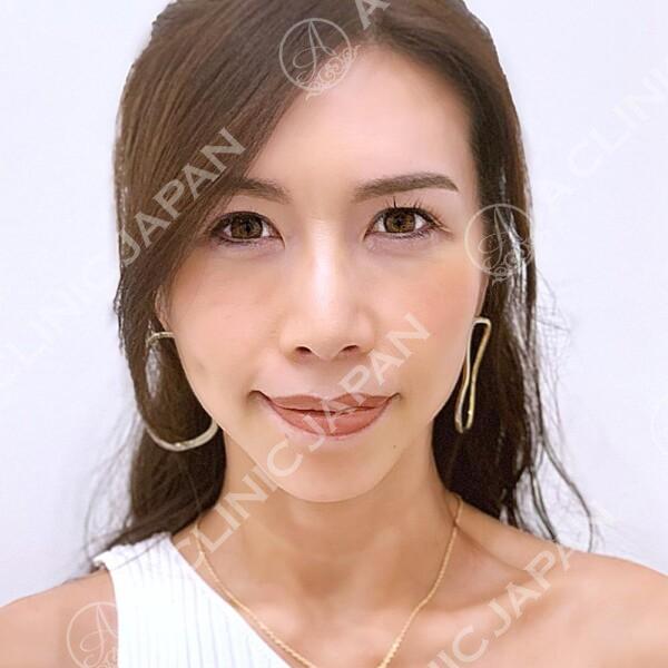 即日変化を実感！たるみを引き上げて若々しいフェイスラインになりました♪(40代女性) AFTER