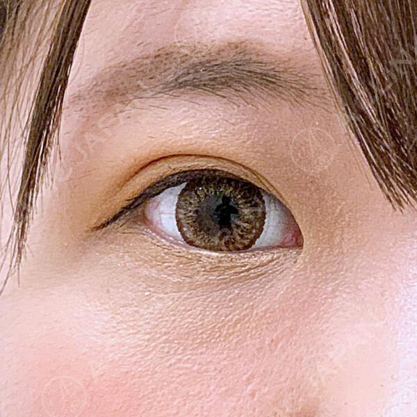 二重術埋没法で目がぱっちりで目つきの悪さも改善 AFTER