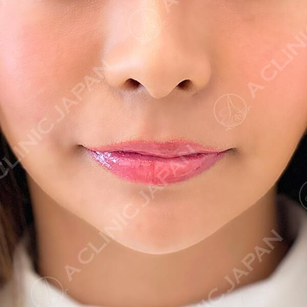 子猫のような口元になって愛され美人に変身です BEFORE