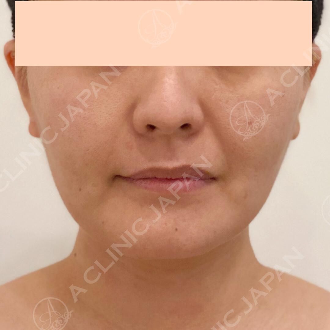 腫れの少ない切開リフト法でたるみをグッと引き上げました！処置後5日目の症例写真です♪(30代女性) BEFORE
