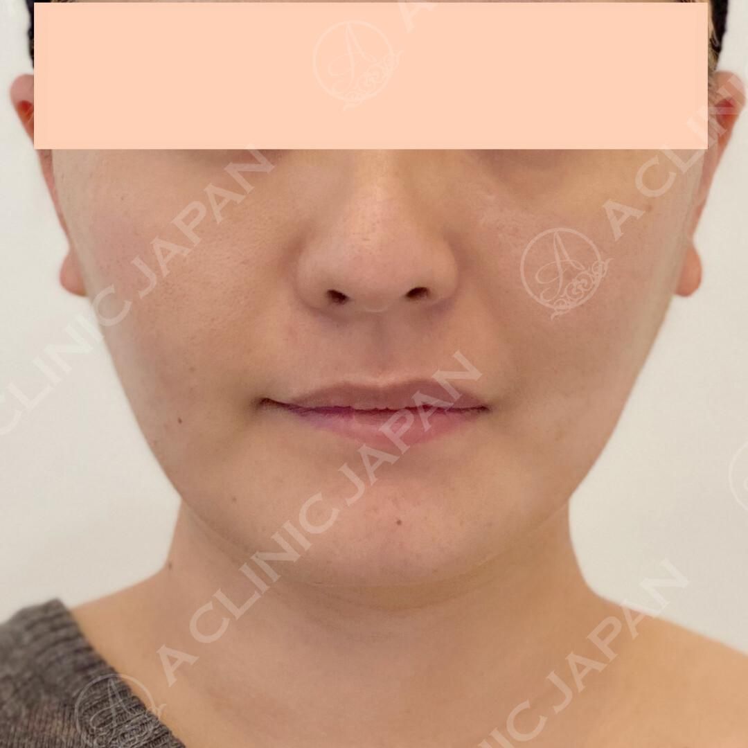 腫れの少ない切開リフト法でたるみをグッと引き上げました！処置後5日目の症例写真です♪(30代女性) AFTER
