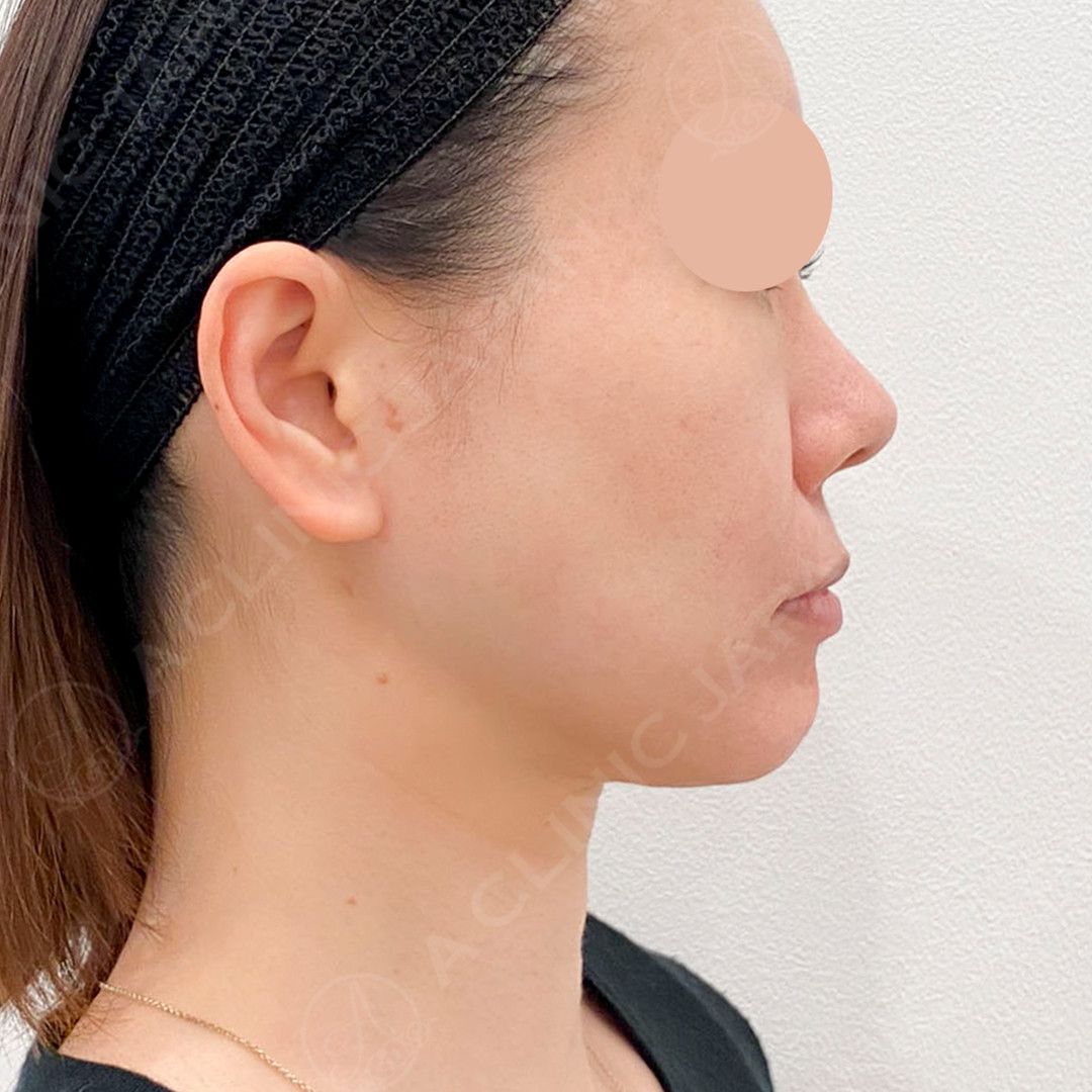 あご下の脂肪やたるも1回でここまでスッキリします！1day小顔脂肪吸引の処置前と3ヶ月後の症例です(40代女性) AFTER