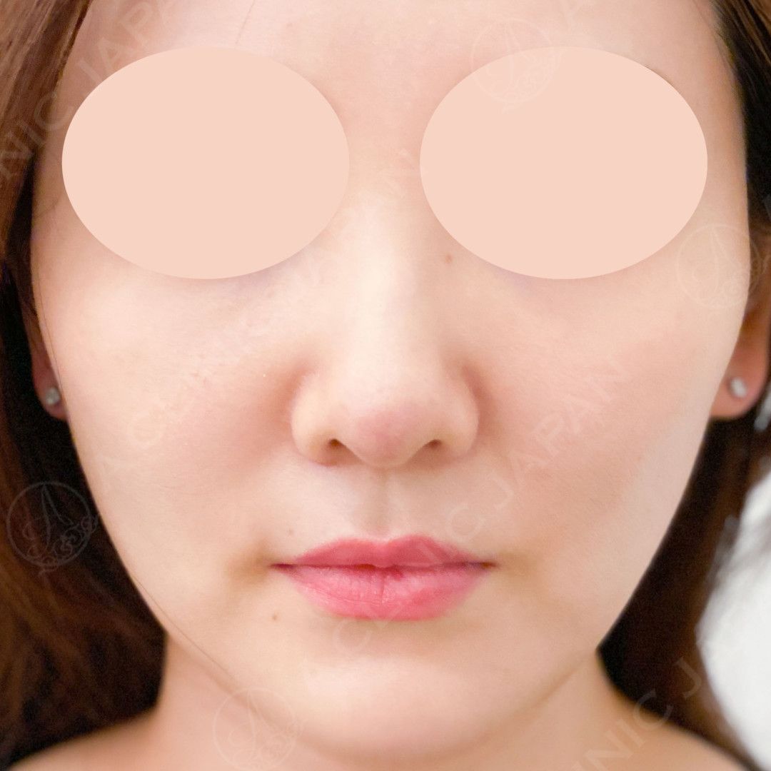 耳介軟骨移植(鼻尖形成)で鼻先を細く高く理想の鼻に導きます！処置前と2週間後の症例です(30代女性) AFTER