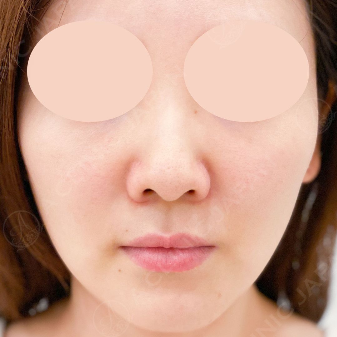 耳介軟骨移植(鼻尖形成)で鼻先を細く高く理想の鼻に導きます！処置前と2週間後の症例です(30代女性) BEFORE