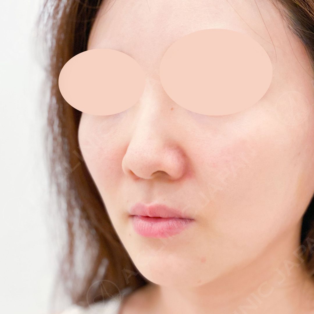 耳介軟骨移植(鼻尖形成)で鼻先がシャープに整いました！処置前と2週間後の症例です(30代女性) BEFORE