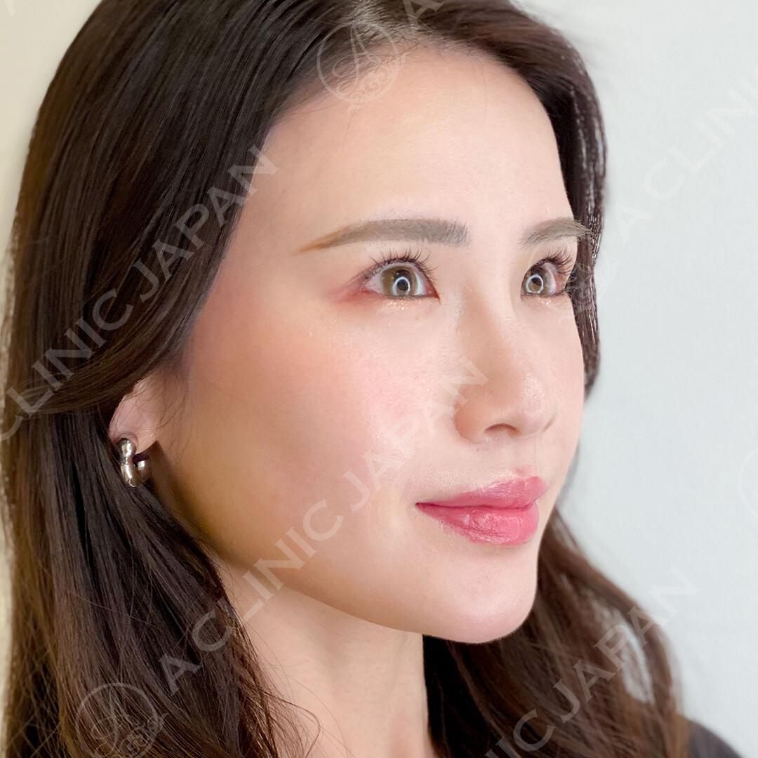 吊り目気味の目元をパーフェクトアイズでしっかりタレ目に！処置前と2週間後の症例です(20代女性) AFTER