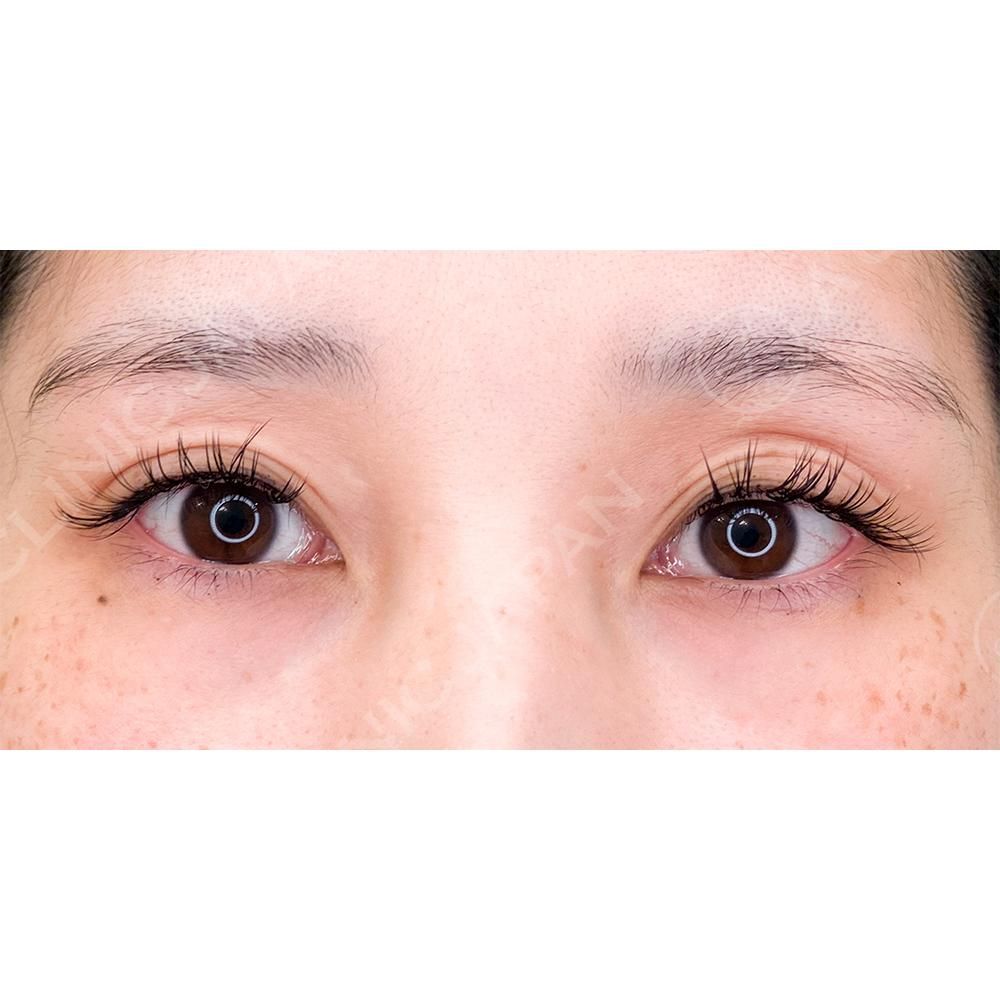 ナチュラル可愛いA CLINICのたれ目形成術！パーフェクトアイズの処置前と2週間後の症例です(30代女性) BEFORE