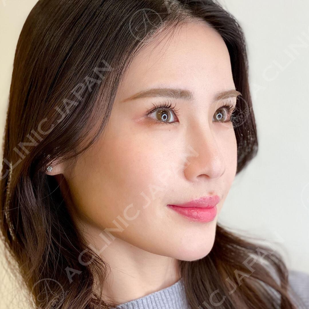 吊り目気味の目元をパーフェクトアイズでしっかりタレ目に！処置前と2週間後の症例です(20代女性) BEFORE