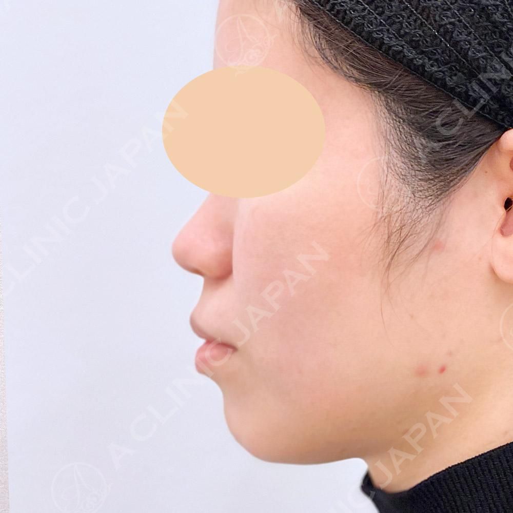 耳介軟骨移植(鼻尖形成)で綺麗な鼻筋になれる！処置前と1週間後の症例です（20代女性） AFTER