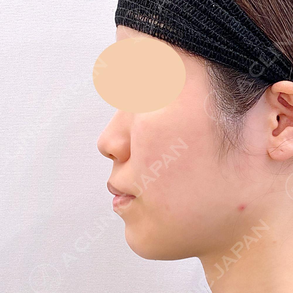 耳介軟骨移植(鼻尖形成)で綺麗な鼻筋になれる！処置前と1週間後の症例です（20代女性） BEFORE