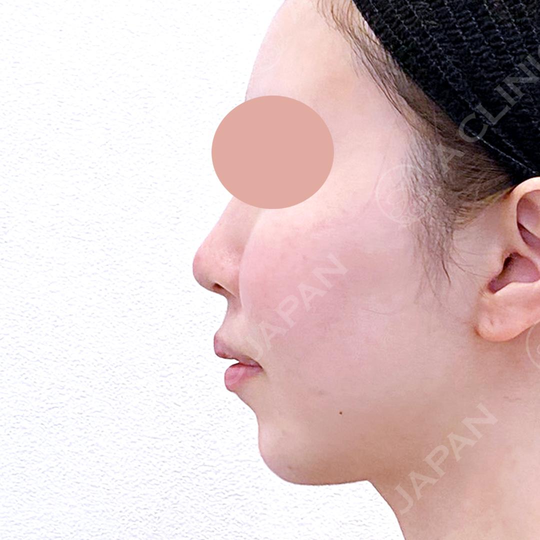 お鼻が高くなり顔の重心もキュッと上向きに！耳介軟骨移植(鼻尖形成)と鼻先縮小術の処置前と2週間後の症例です(20代女性) AFTER