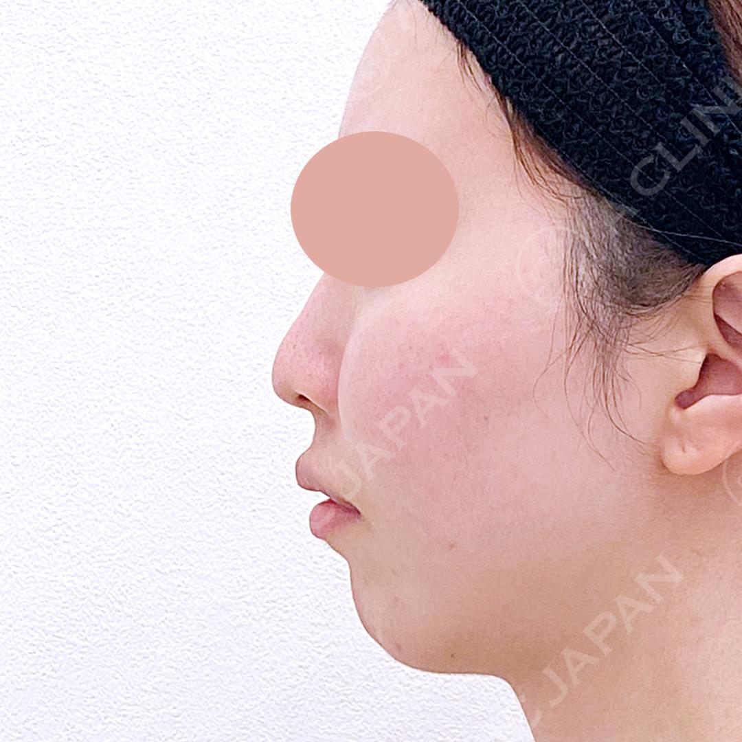 お鼻が高くなり顔の重心もキュッと上向きに！耳介軟骨移植(鼻尖形成)と鼻先縮小術の処置前と2週間後の症例です(20代女性) BEFORE