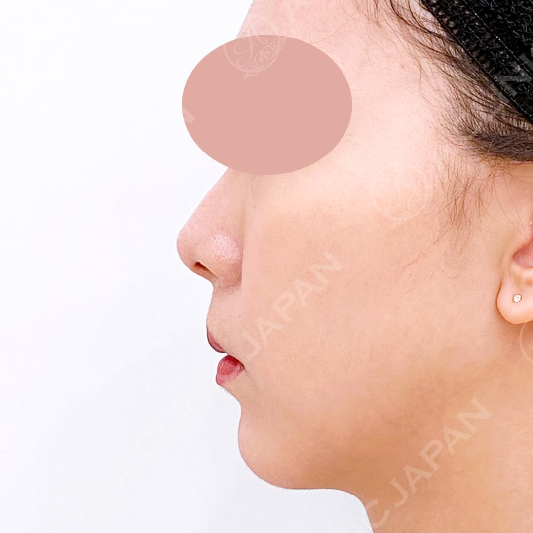 耳介軟骨移植(鼻尖形成)で自然とツンとした美しい鼻先へ！処置前と2週間後の症例です(20代女性) AFTER