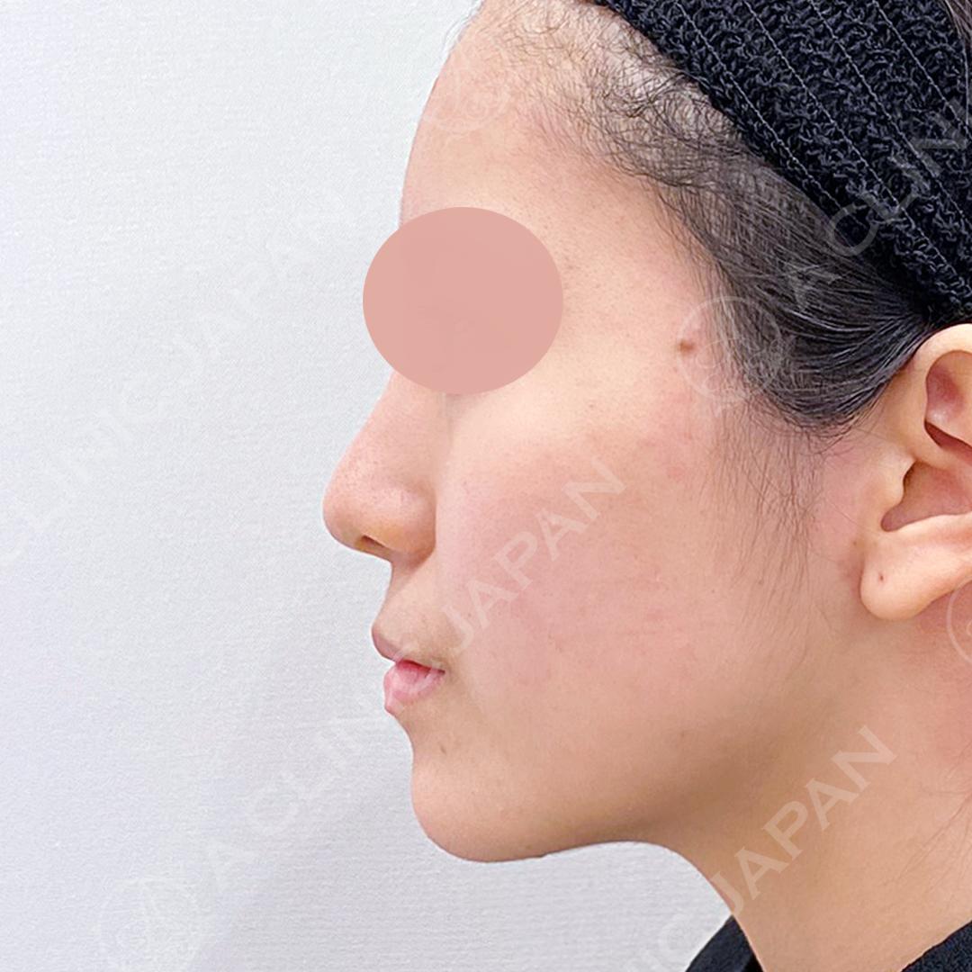 その日から自然に美しい鼻先をゲット！耳介軟骨移植(鼻尖形成)の処置前と処置直後の症例です(20代女性) AFTER