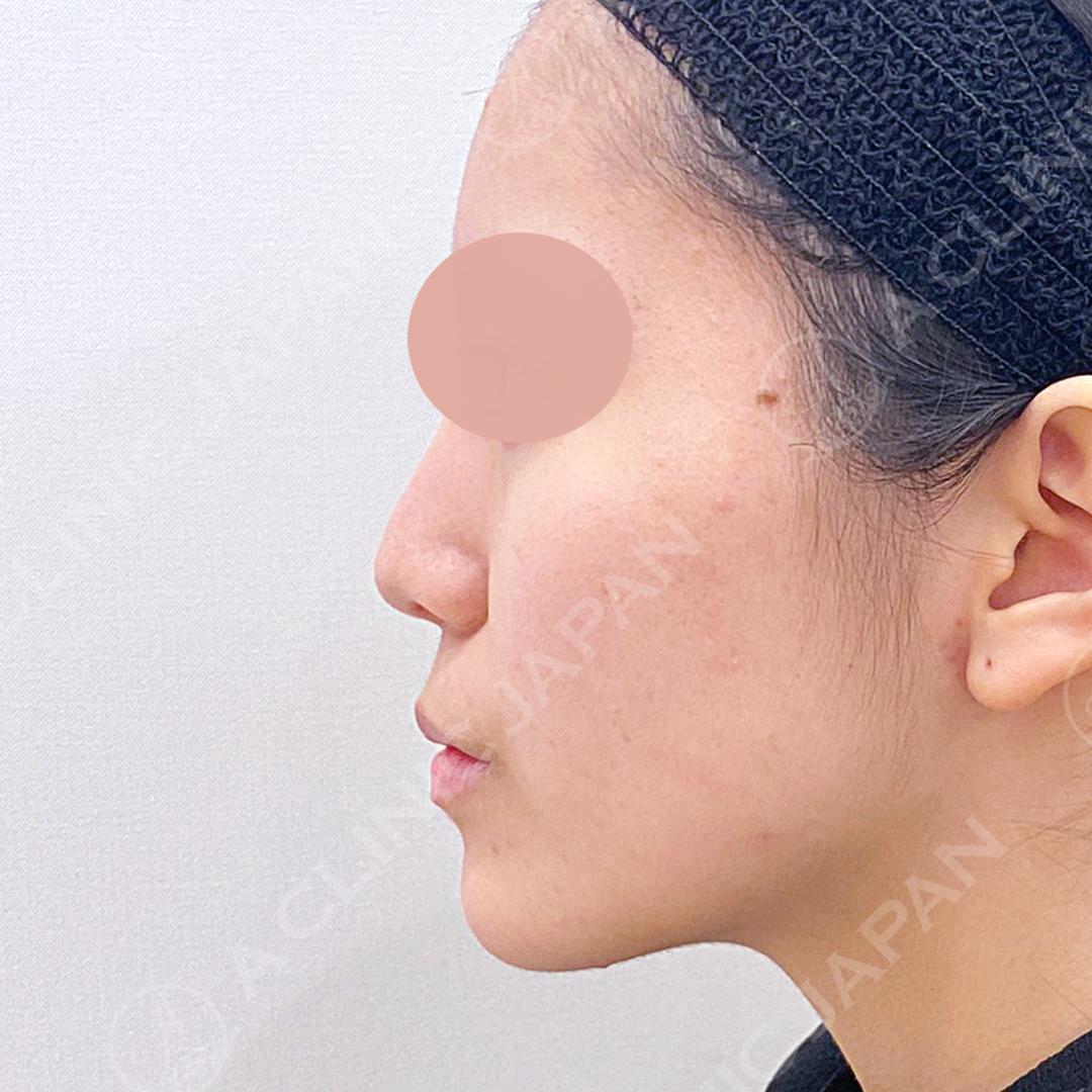その日から自然に美しい鼻先をゲット！耳介軟骨移植(鼻尖形成)の処置前と処置直後の症例です(20代女性) BEFORE
