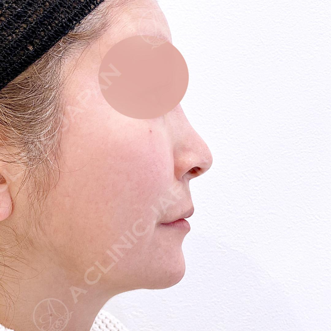 ツンと美しい鼻先でEラインが華やかに！耳介軟骨移植(鼻尖形成)の処置前と１ヶ月後の症例です(50代女性) BEFORE