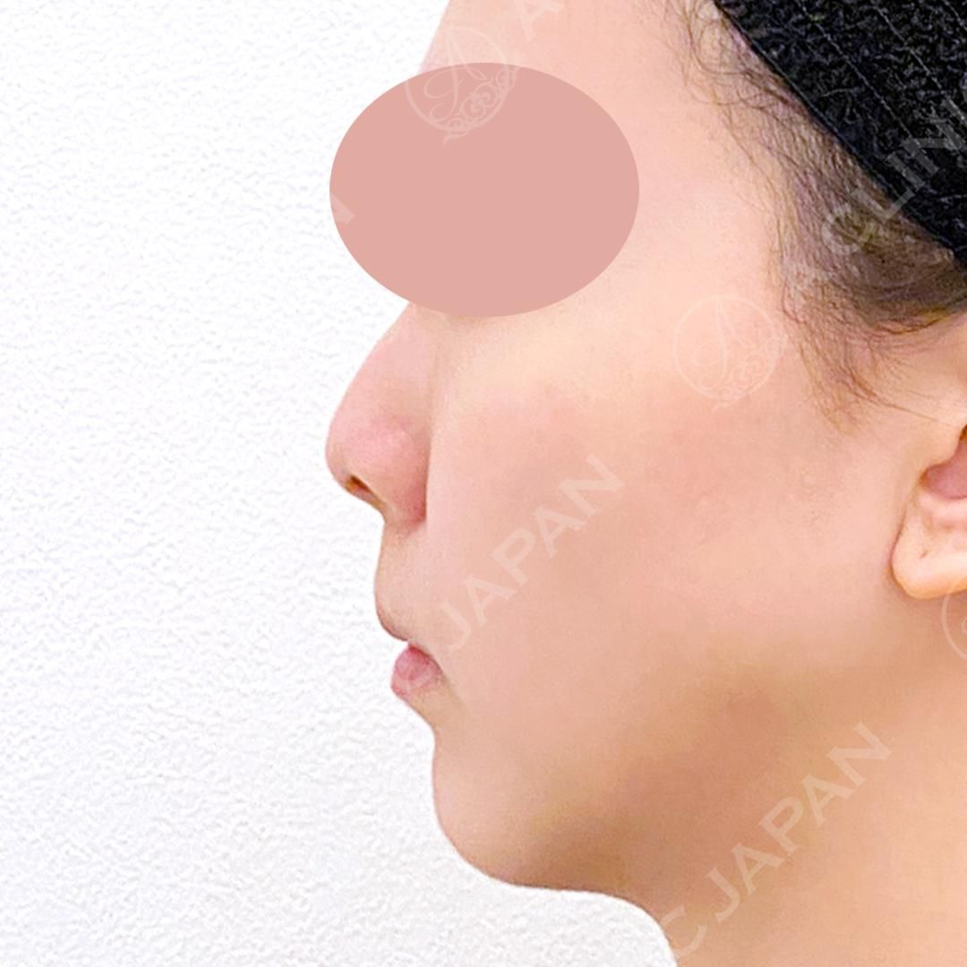 耳介軟骨移植(鼻尖形成)で自然とツンとした美しい鼻先へ！処置前と2週間後の症例です(20代女性) BEFORE