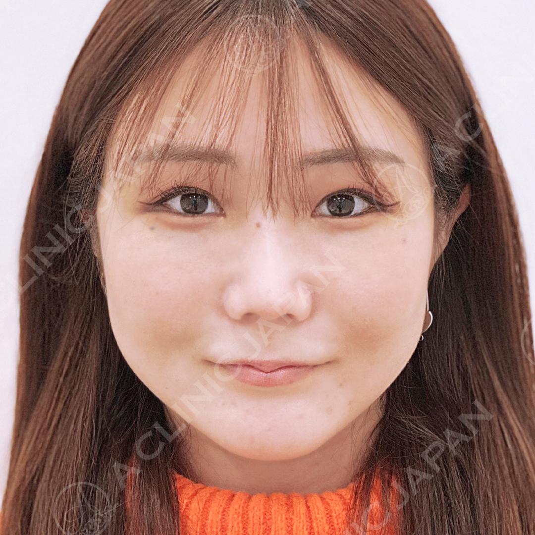 顔の横幅縮小術(脂肪吸引)after2