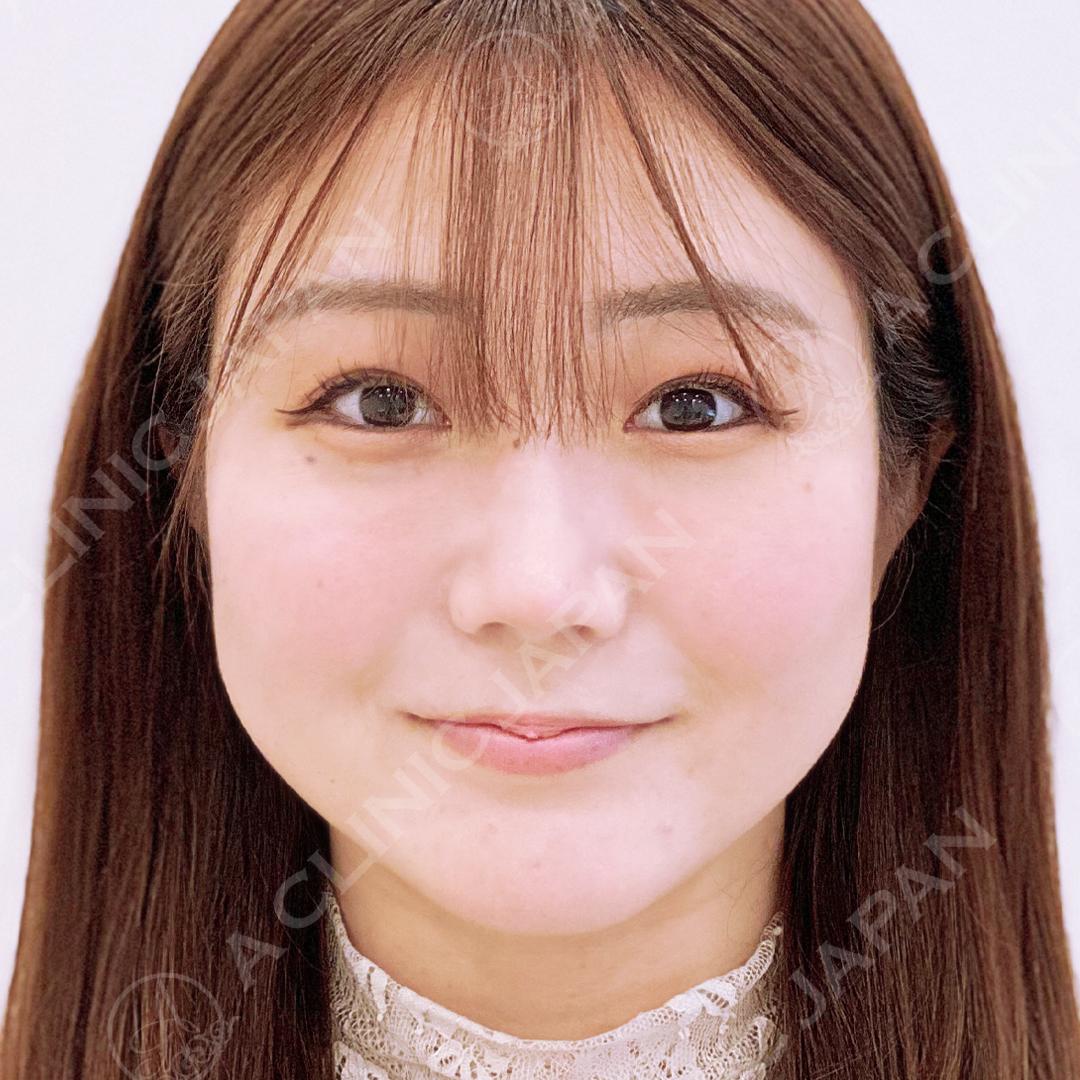 顔の横幅縮小術(脂肪吸引)before2