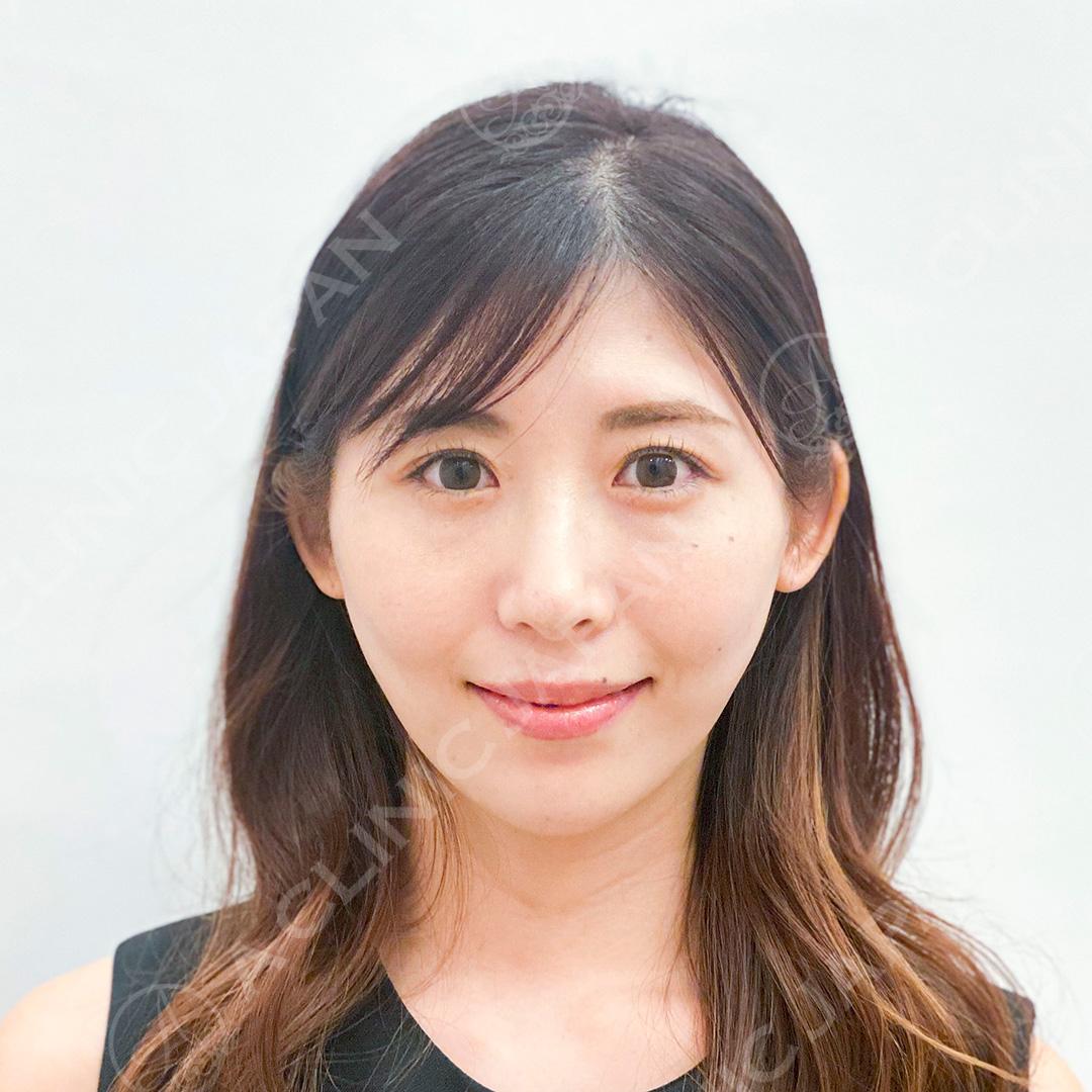 お顔の丸みが気になる方もAスレッドなら直後から解決できます！こちら処置前と処置直後の症例写真です(30代女性) AFTER