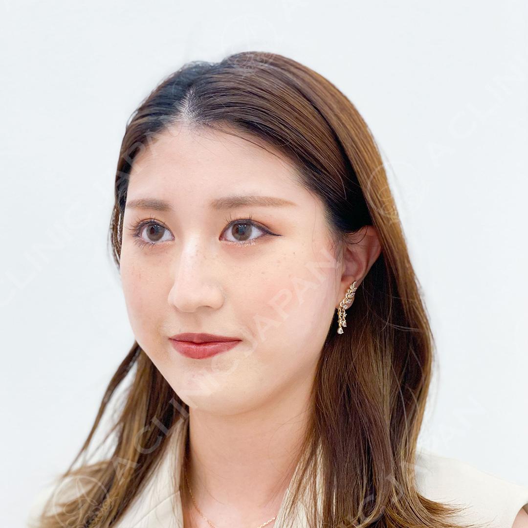 Aスレッドでフェイスラインの骨のラインが見えるようになりました♪処置前と処置直後の症例です(20代女性) AFTER