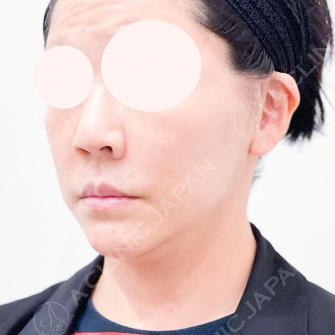A式美肌たるみ切開で斜めから見えるフェイスラインもスッキリ♪処置前と処置直後の症例です(40代女性) AFTER