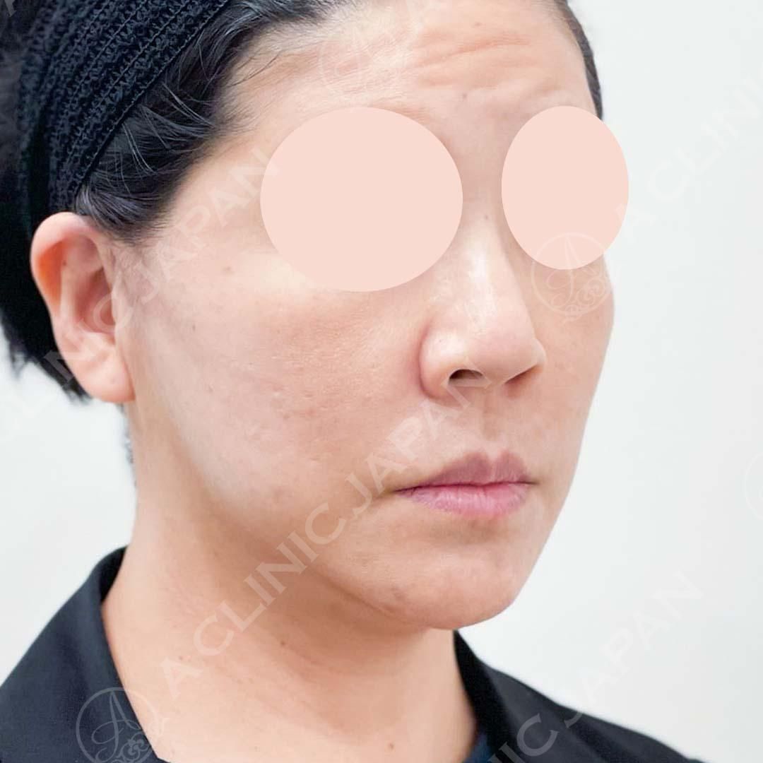 A式美肌たるみ切開で頬のもたつきが改善されてフェイスラインがスッキリしました！処置前と処置直後の症例です(40代女性) AFTER