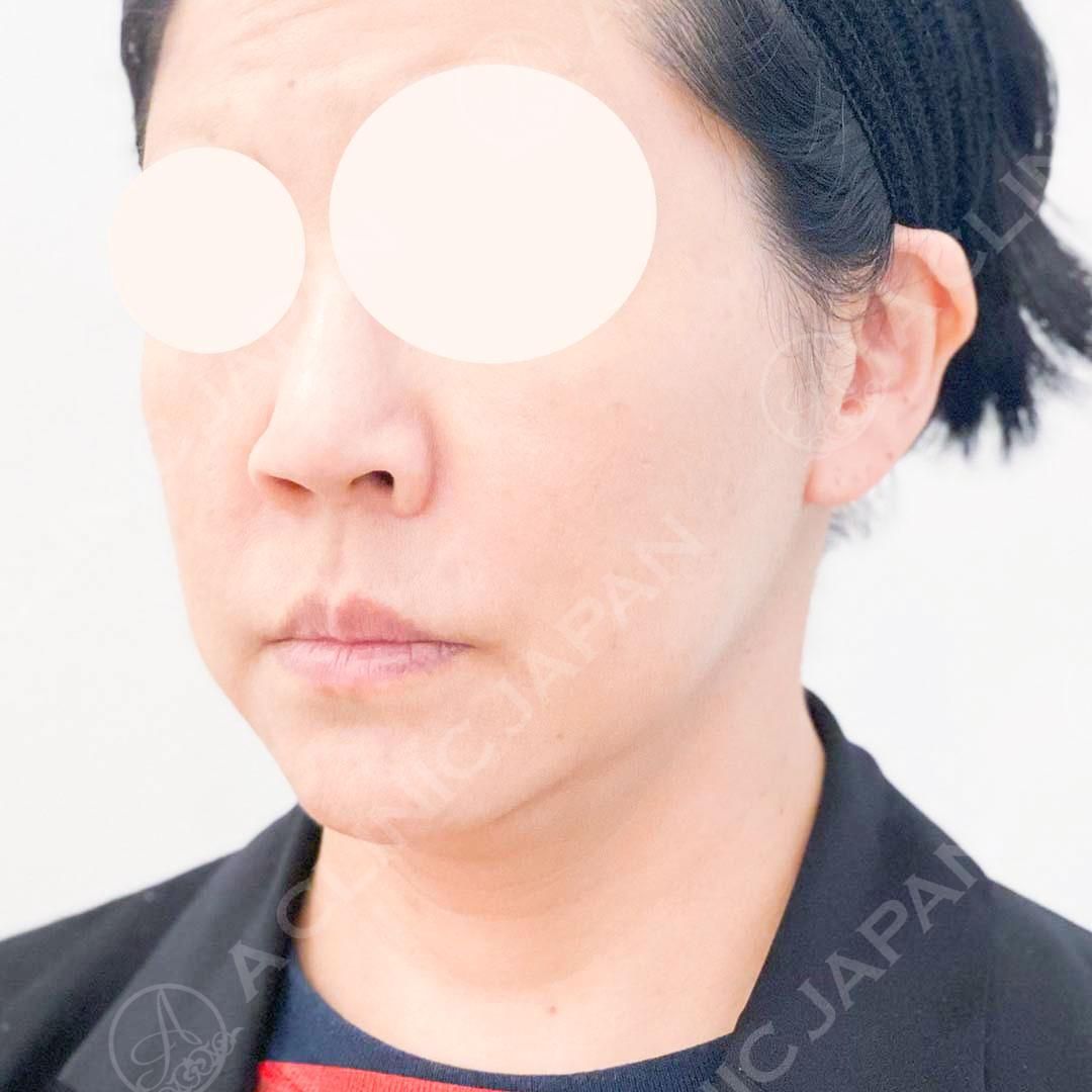 A式美肌たるみ切開で斜めから見えるフェイスラインもスッキリ♪処置前と処置直後の症例です(40代女性) BEFORE