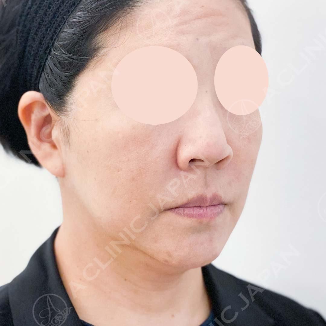 A式美肌たるみ切開で頬のもたつきが改善されてフェイスラインがスッキリしました！処置前と処置直後の症例です(40代女性) BEFORE