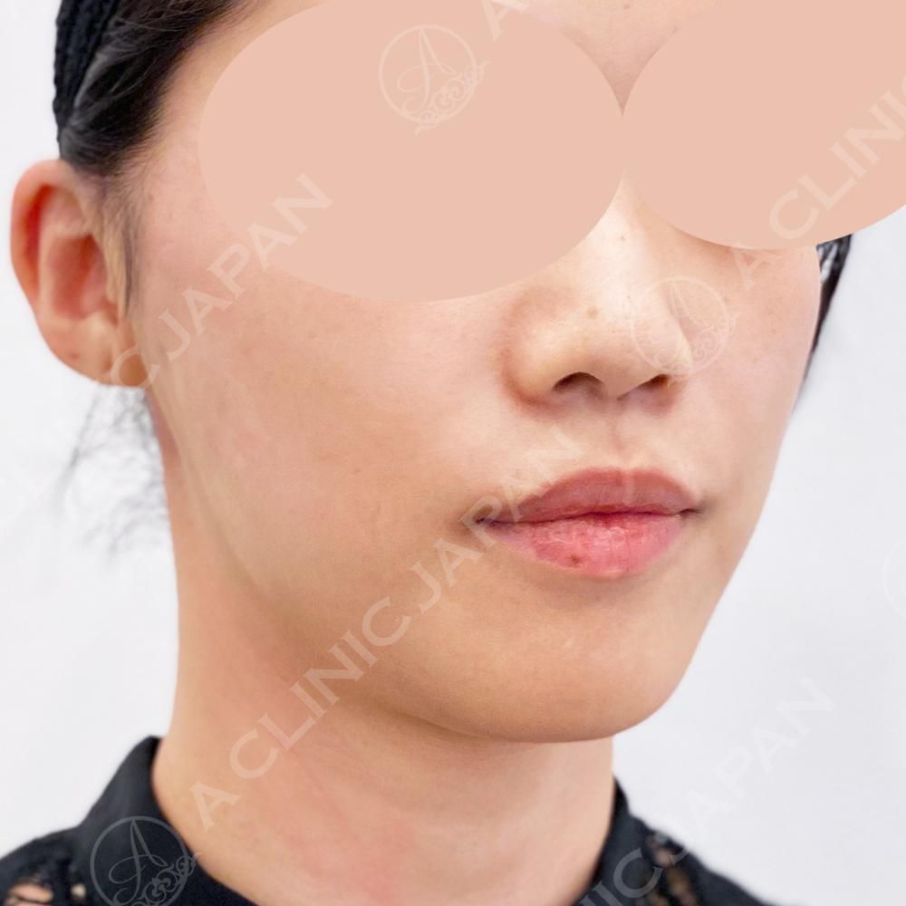 直後から腫れもなくリフトアップ！A式美肌たるみ切開の処置前と処置直後の症例です(30代女性) AFTER