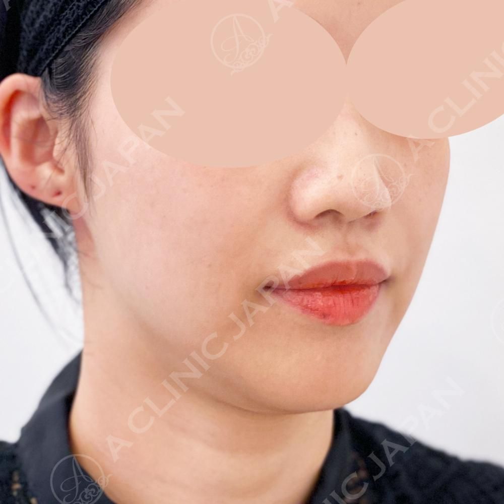 直後から腫れもなくリフトアップ！A式美肌たるみ切開の処置前と処置直後の症例です(30代女性) BEFORE